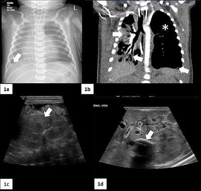 Combined novel homozygous variants in both SGPL1 and STAT1 presenting with severe combined immune deficiency: case report and literature review